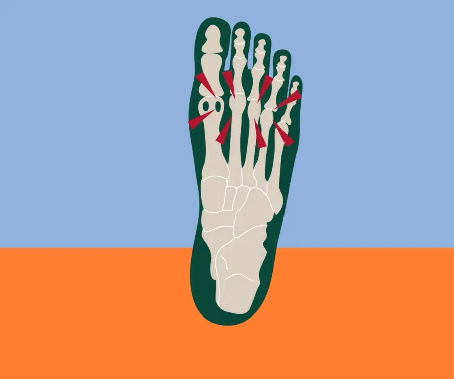 Metatarsal Pad Comfort