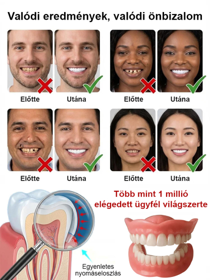 【Hollywood-i mosoly újraalkotása】Erős tapadású orvosi teljes műfogsor