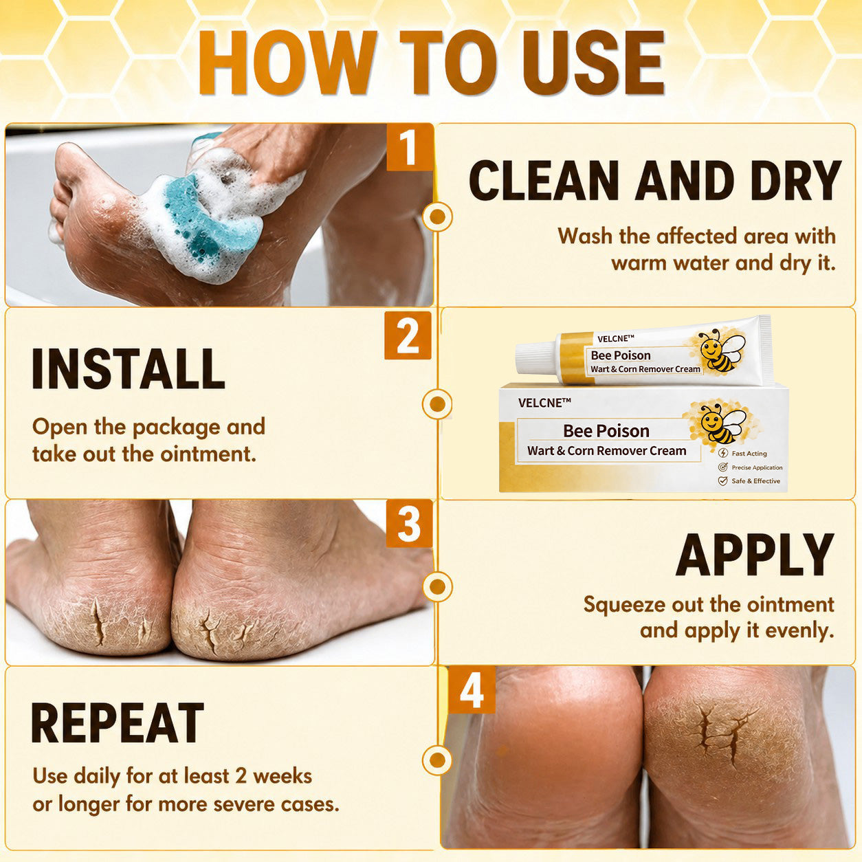 👨‍⚕️Velcne™Bee Poison Wart & Corn Remover Cream⚡