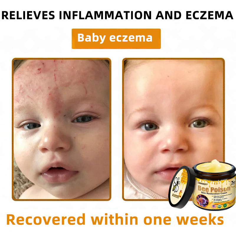 LOVILDS™ 🐝Bee Poison Skin Restoration Cream 🐝