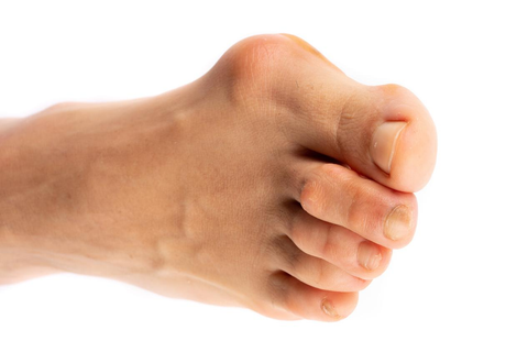 Bunions affects 1/3 of American adults.