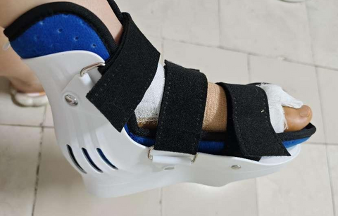 After Bunion surgery