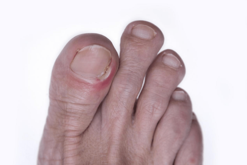 The Ultimate Guide to Sandals for Ingrown Toenail Care and Recovery - FitVille