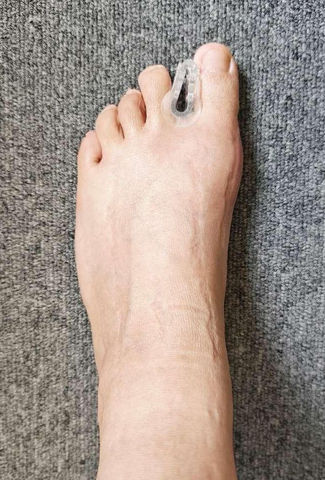 Silicon Bunion Toe Separators