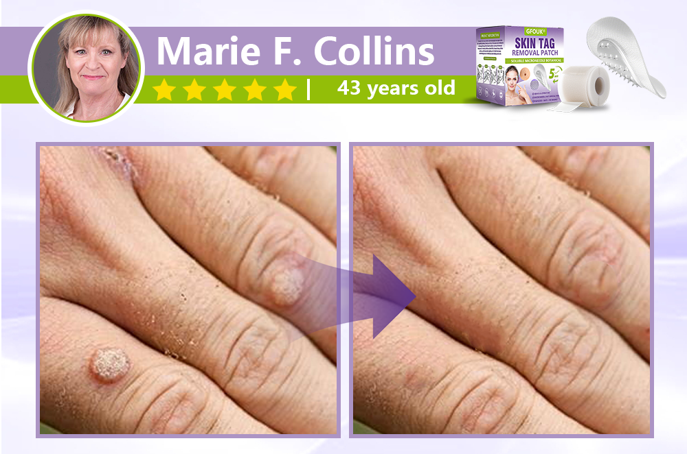 GFOUK&reg; Soluble Microneedle Botanical Skin Tag Removal Patch