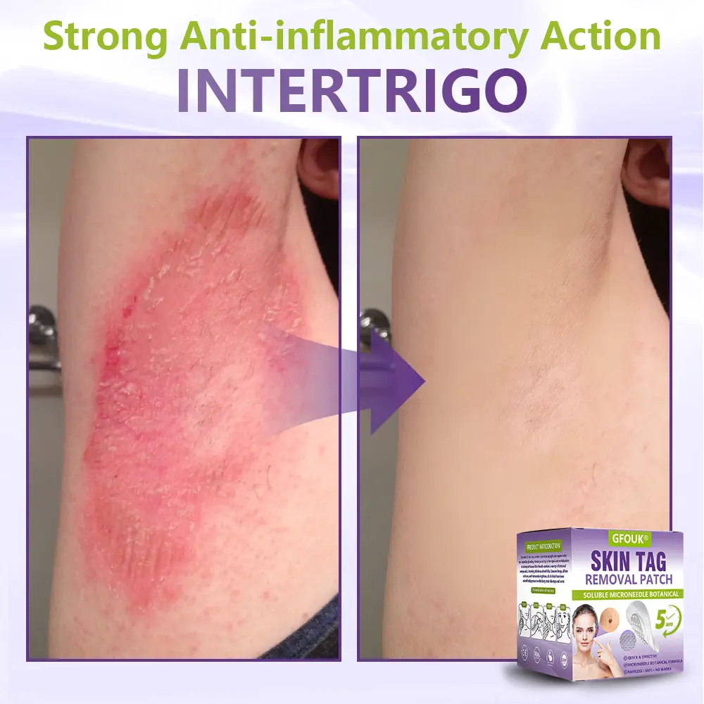 Soluble Microneedle Botanical Skin Tag Removal Patch