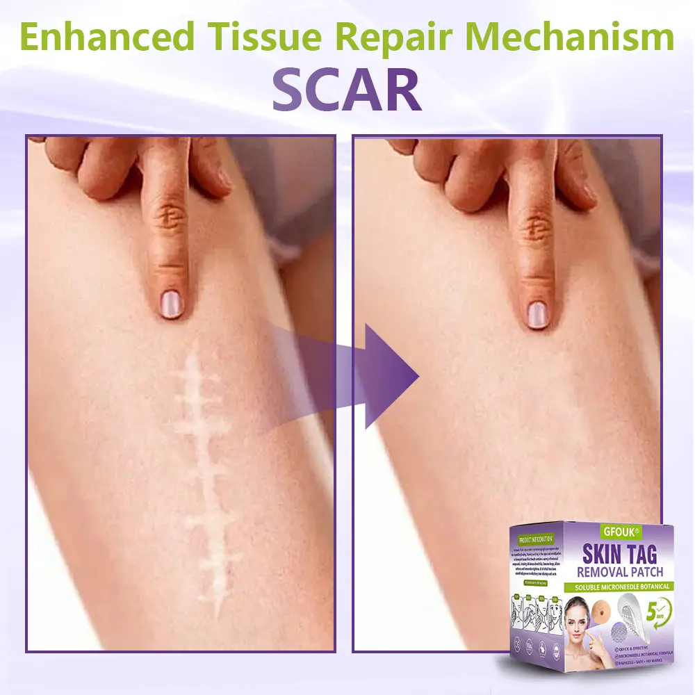 Soluble Microneedle Botanical Skin Tag Removal Patch