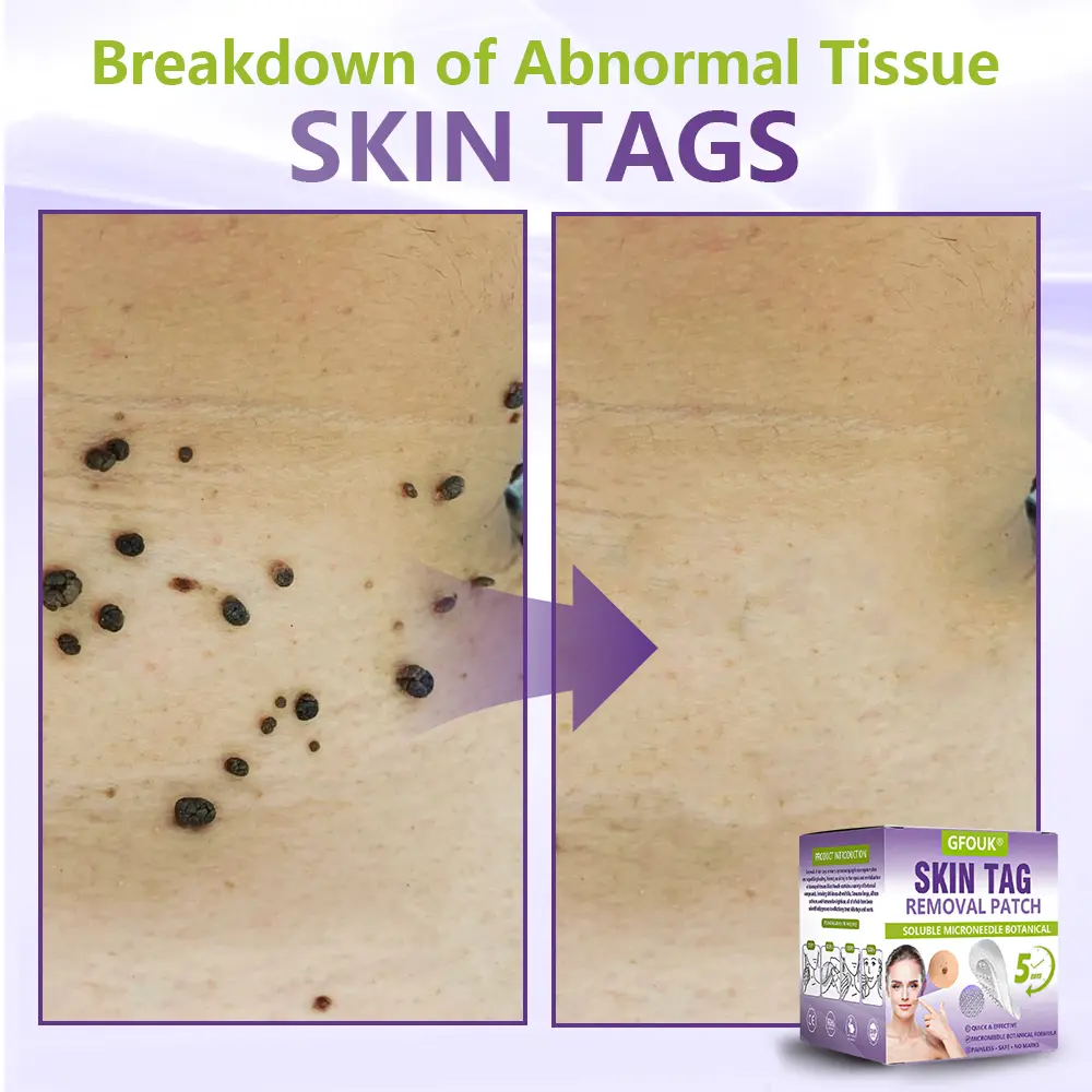 Soluble Microneedle Botanical Skin Tag Removal Patch