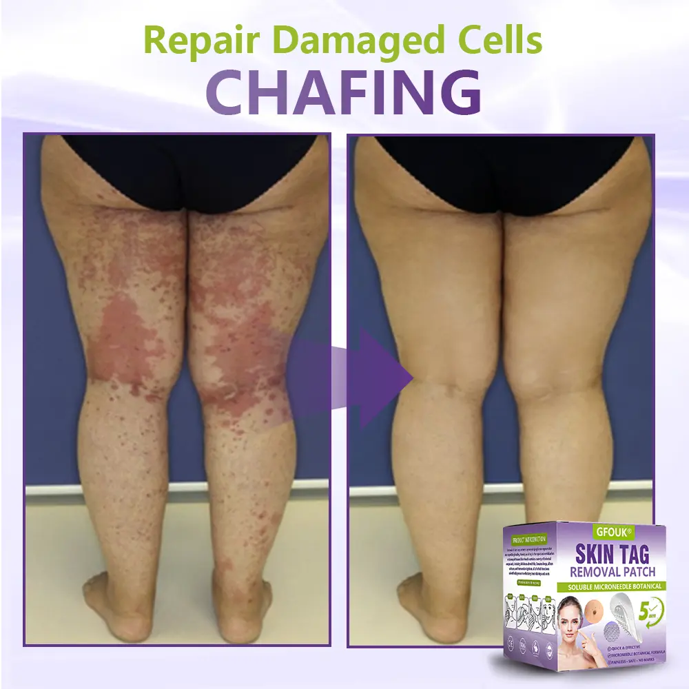 Soluble Microneedle Botanical Skin Tag Removal Patch