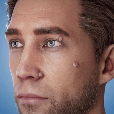 GFOUK&reg; Soluble Microneedle Botanical Skin Tag Removal Patch