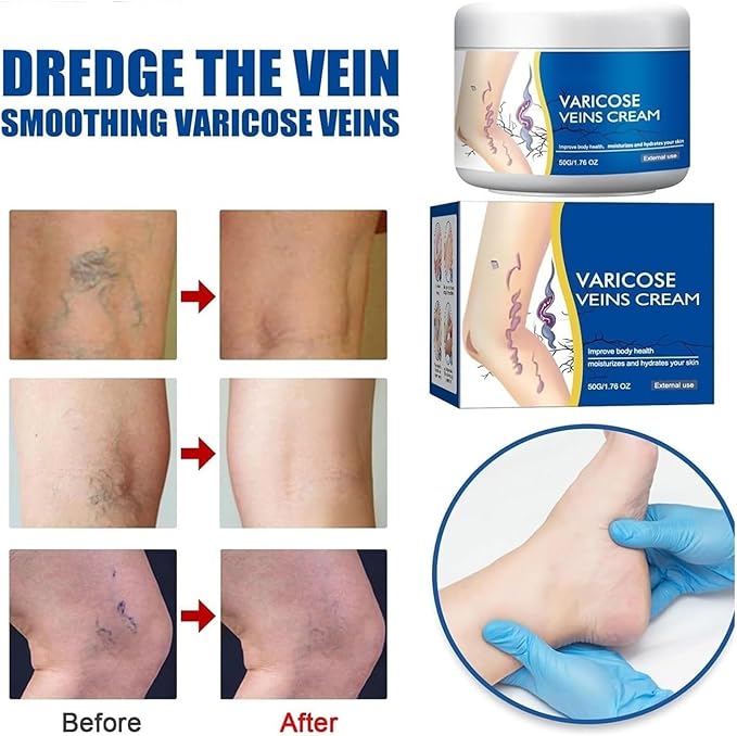 Varicose Veins Cream