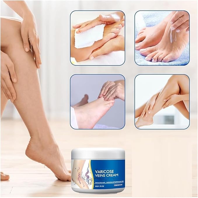 Varicose Veins Cream