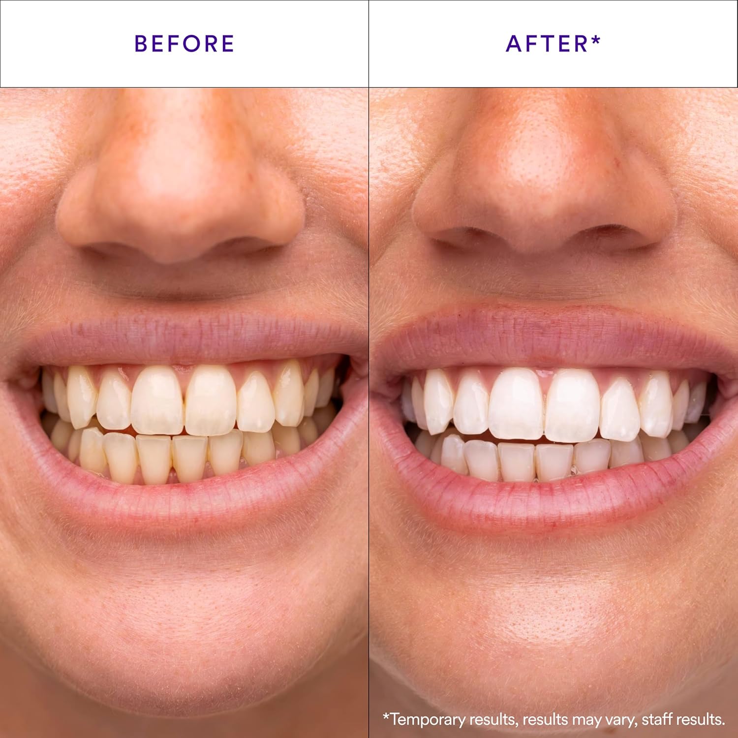 Hismile V34 Whitening Strips, Combining Whitening and Colour Correction