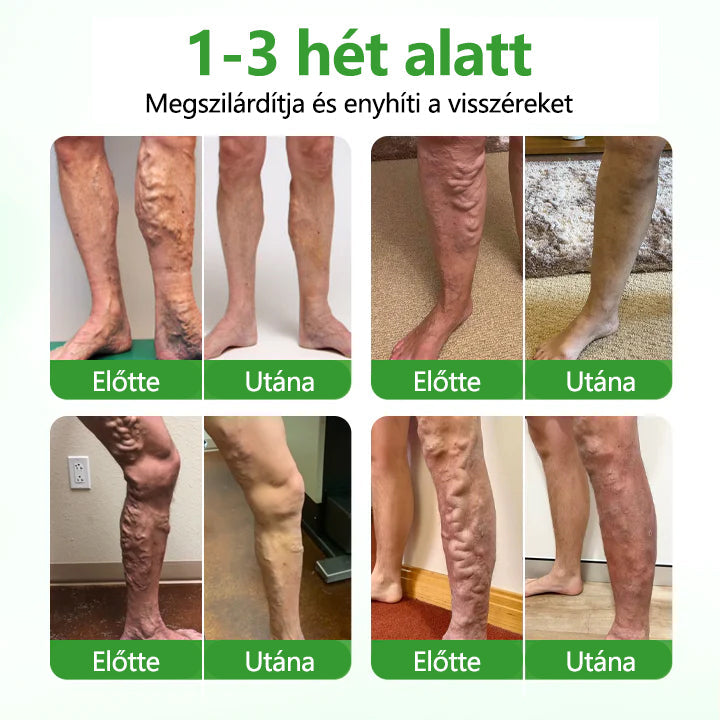 🌿Laleia® VeinHeal mikrotűs tapasz