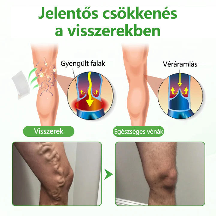 🌿Laleia® VeinHeal mikrotűs tapasz
