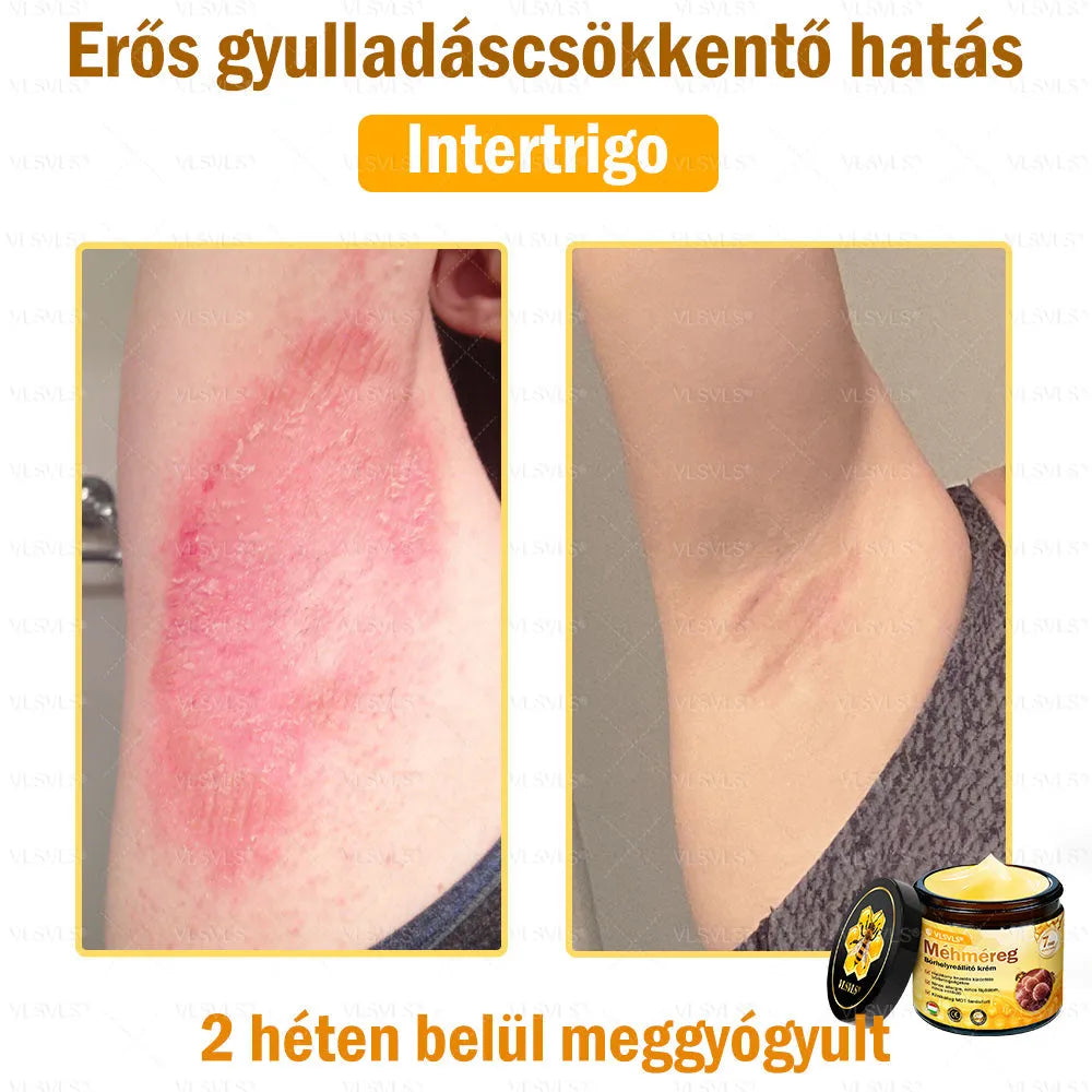 VLSVLS® Méhméreg Bőrhelyreállító Krém (👨‍⚕‍CE jóváhagyott)👍✅