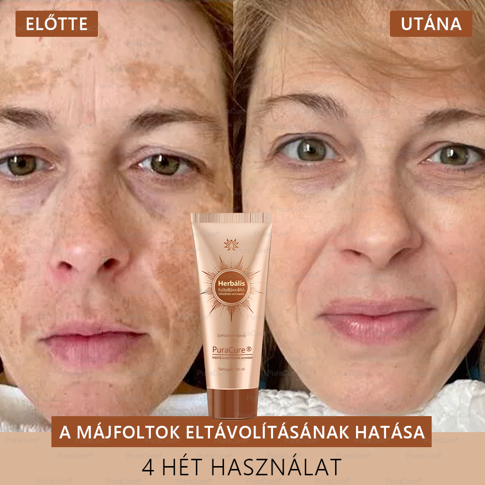💟𝗣𝘂𝗿𝗮𝗖𝘂𝗿𝗲®Fehérítő És Folteltávolító Arcmaszk | Természetes összetevők tartósan eltüntetik a foltokat, szeplőket és napfoltokat✨✨✨