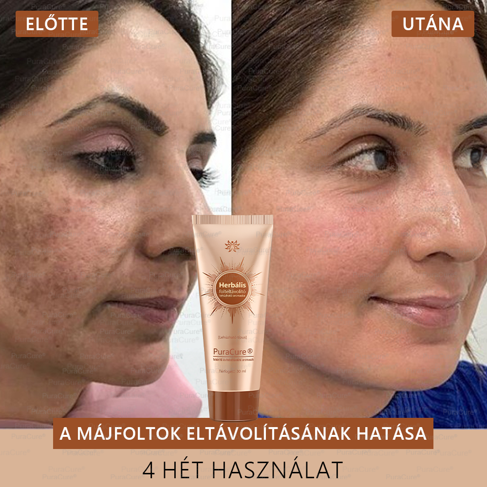 💟𝗣𝘂𝗿𝗮𝗖𝘂𝗿𝗲®Fehérítő És Folteltávolító Arcmaszk | Természetes összetevők tartósan eltüntetik a foltokat, szeplőket és napfoltokat✨✨✨
