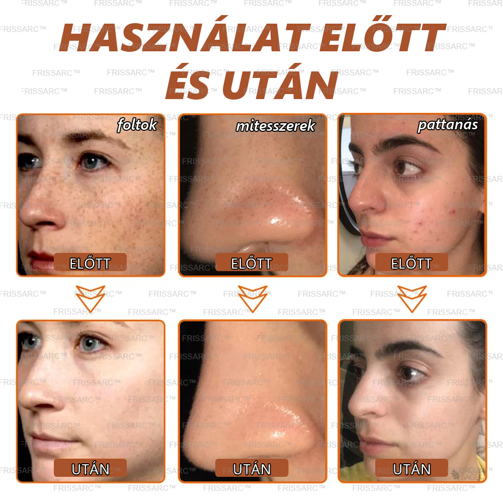 💟𝗣𝘂𝗿𝗮𝗖𝘂𝗿𝗲®Fehérítő És Folteltávolító Arcmaszk | Természetes összetevők tartósan eltüntetik a foltokat, szeplőket és napfoltokat✨✨✨