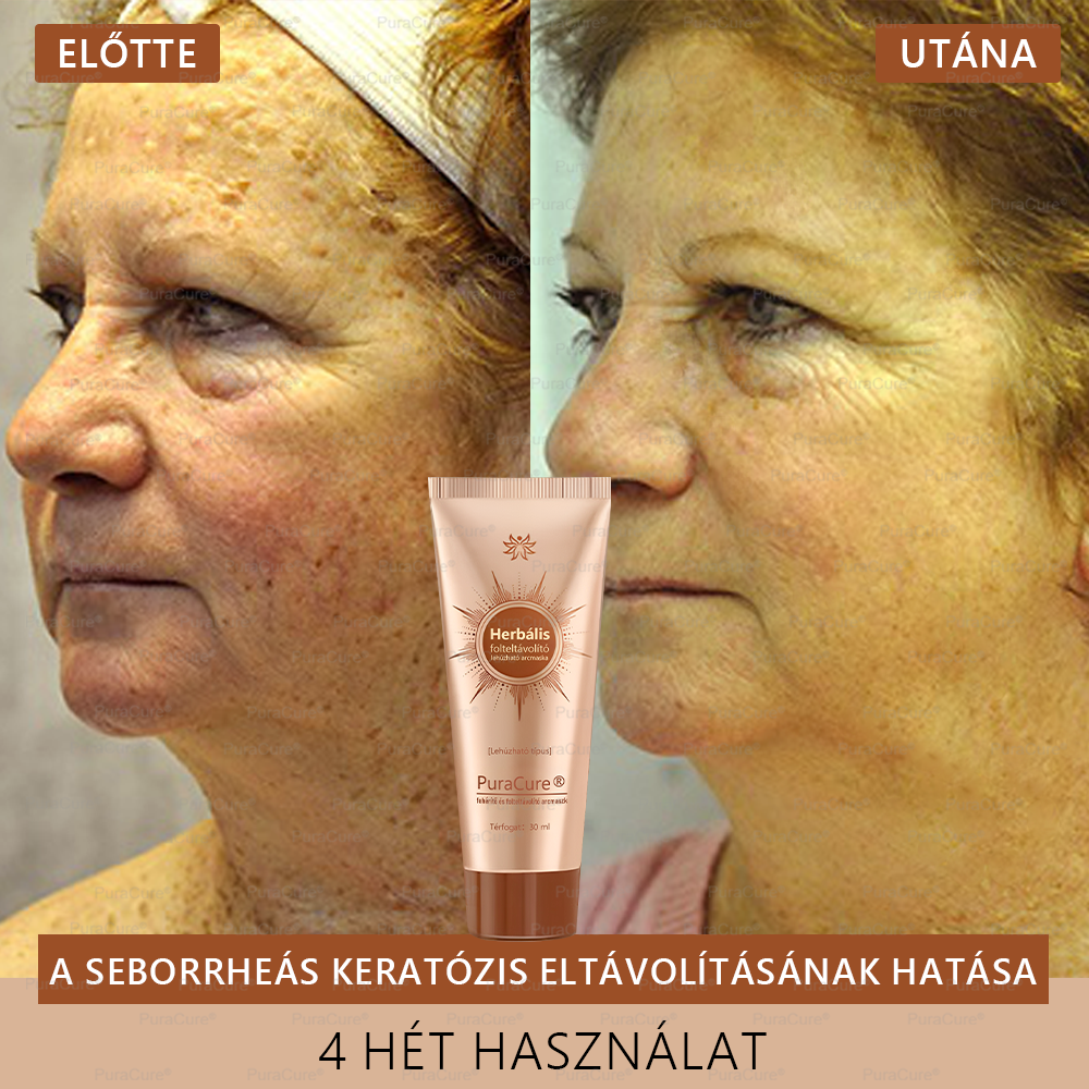 💟𝗣𝘂𝗿𝗮𝗖𝘂𝗿𝗲®Fehérítő És Folteltávolító Arcmaszk | Természetes összetevők tartósan eltüntetik a foltokat, szeplőket és napfoltokat✨✨✨