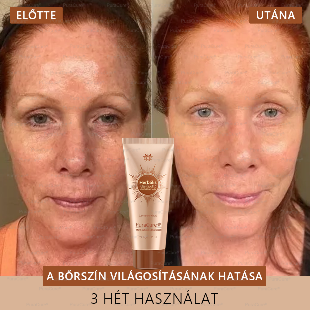 💟𝗣𝘂𝗿𝗮𝗖𝘂𝗿𝗲®Fehérítő És Folteltávolító Arcmaszk | Természetes összetevők tartósan eltüntetik a foltokat, szeplőket és napfoltokat✨✨✨