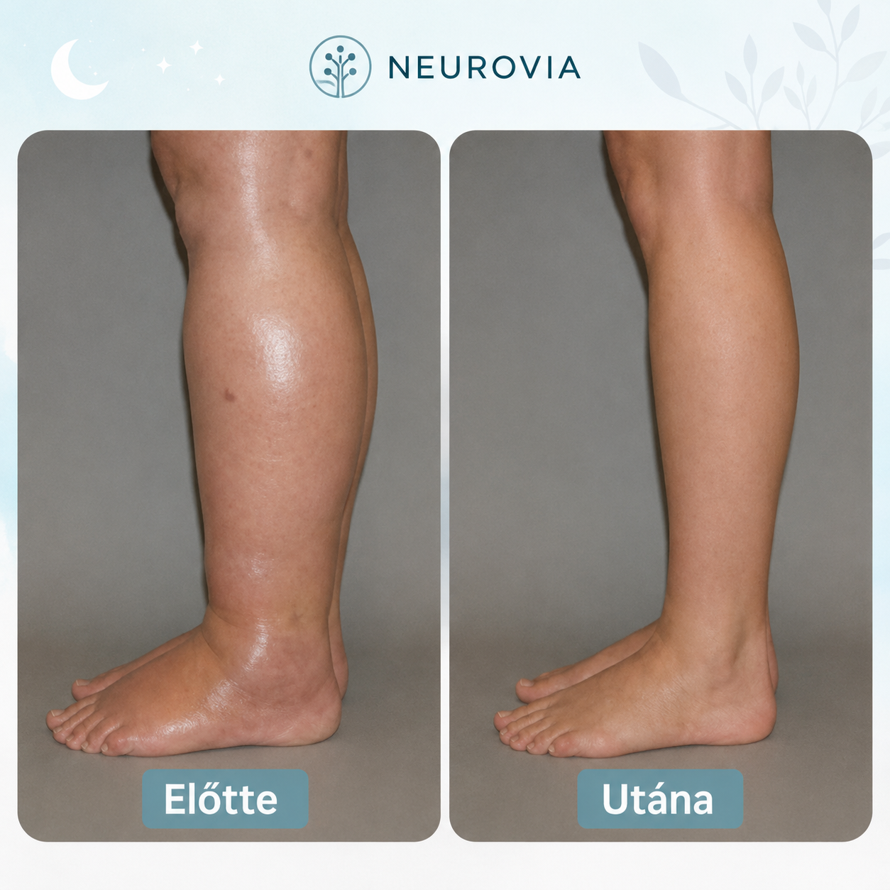 MA: 1+1 INGYEN! Neurovia™ EMS Lábaktiváló Kezelés Duzzadt, nehéz vagy gyengének érződő lábakra – otthoni használatra.