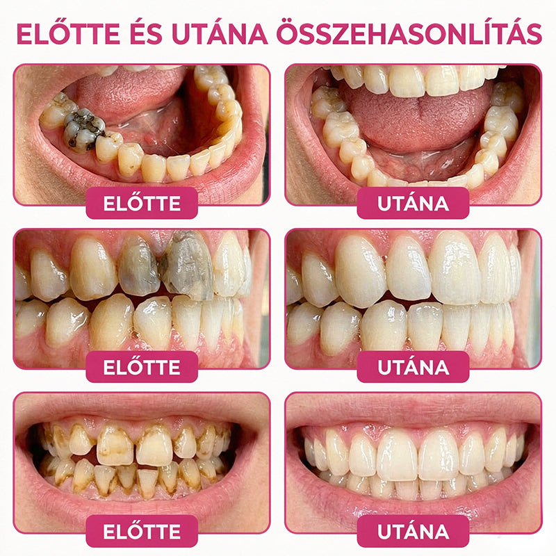 🛡️CleraNaure® DenPerm Üregjavító Természetes Zománctömő Gél