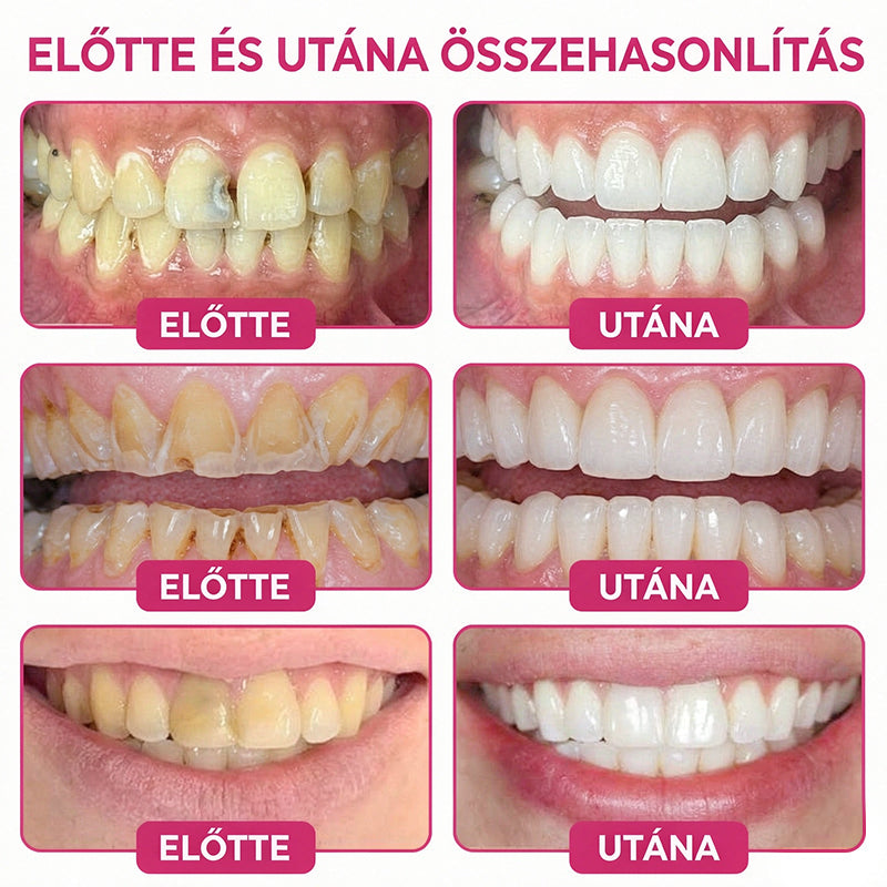 🛡️CleraNaure® DenPerm Üregjavító Természetes Zománctömő Gél