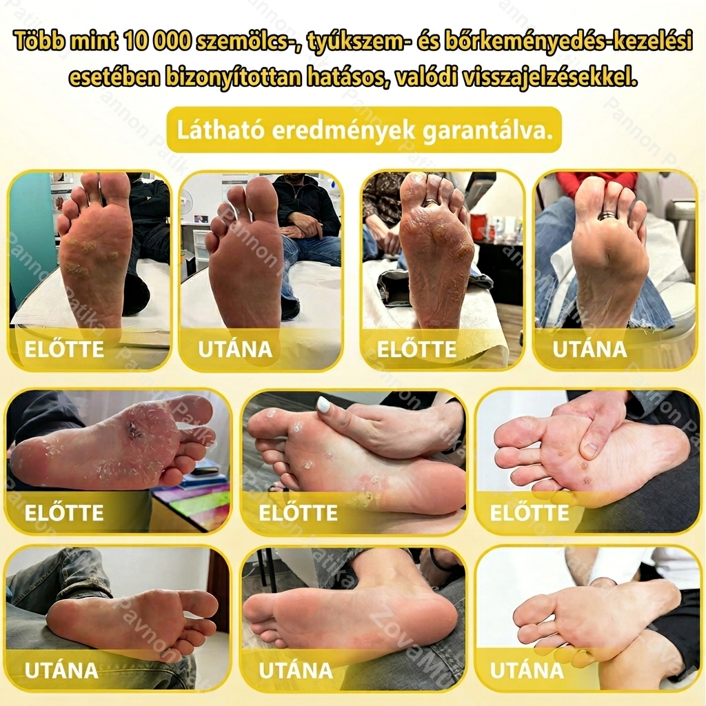 🐝 Méhméreges tyúkszem- és bőrkeményedés-eltávolító krém – Természetes erővel a makacs elváltozások ellen!