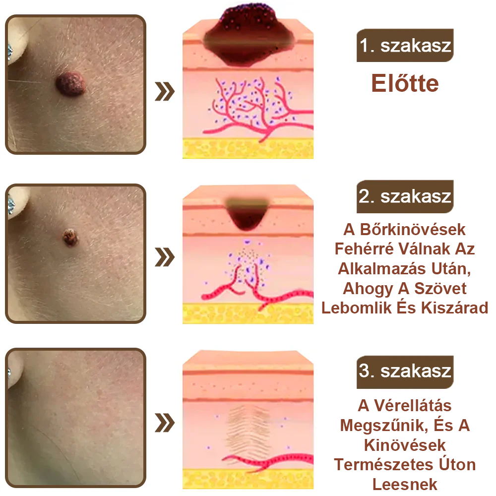 💥 Pureluxo® Fekete Rizses Bőrregeneráló Krém 👨‍⚕️ (Szemölcsök, bőrkinövések, foltok és hiperpigmentáció kezelésére)