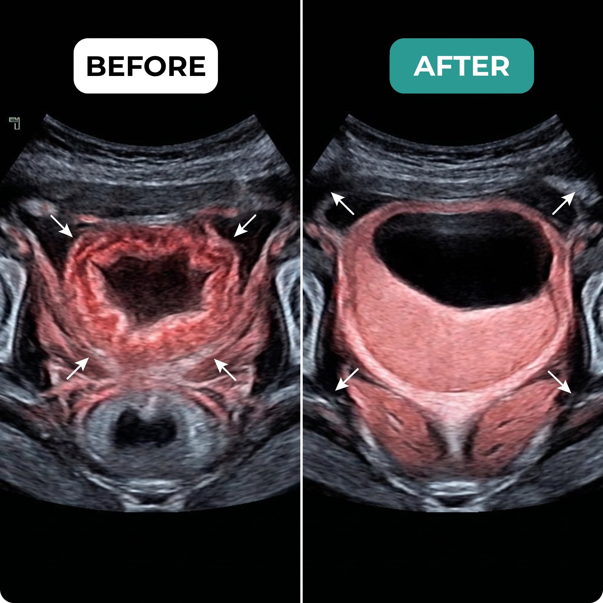 Before and After Bladder Therapy