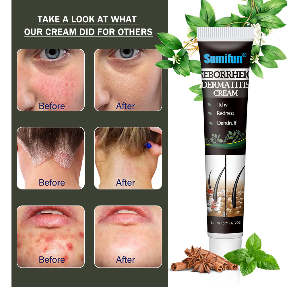 Crema para el cuidado del cuero cabelludo con piel seborreica, picazón y salud del cuero cabelludo.