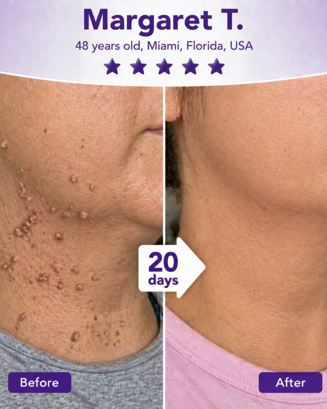 Skin Tags / Moles / Warts Before & After