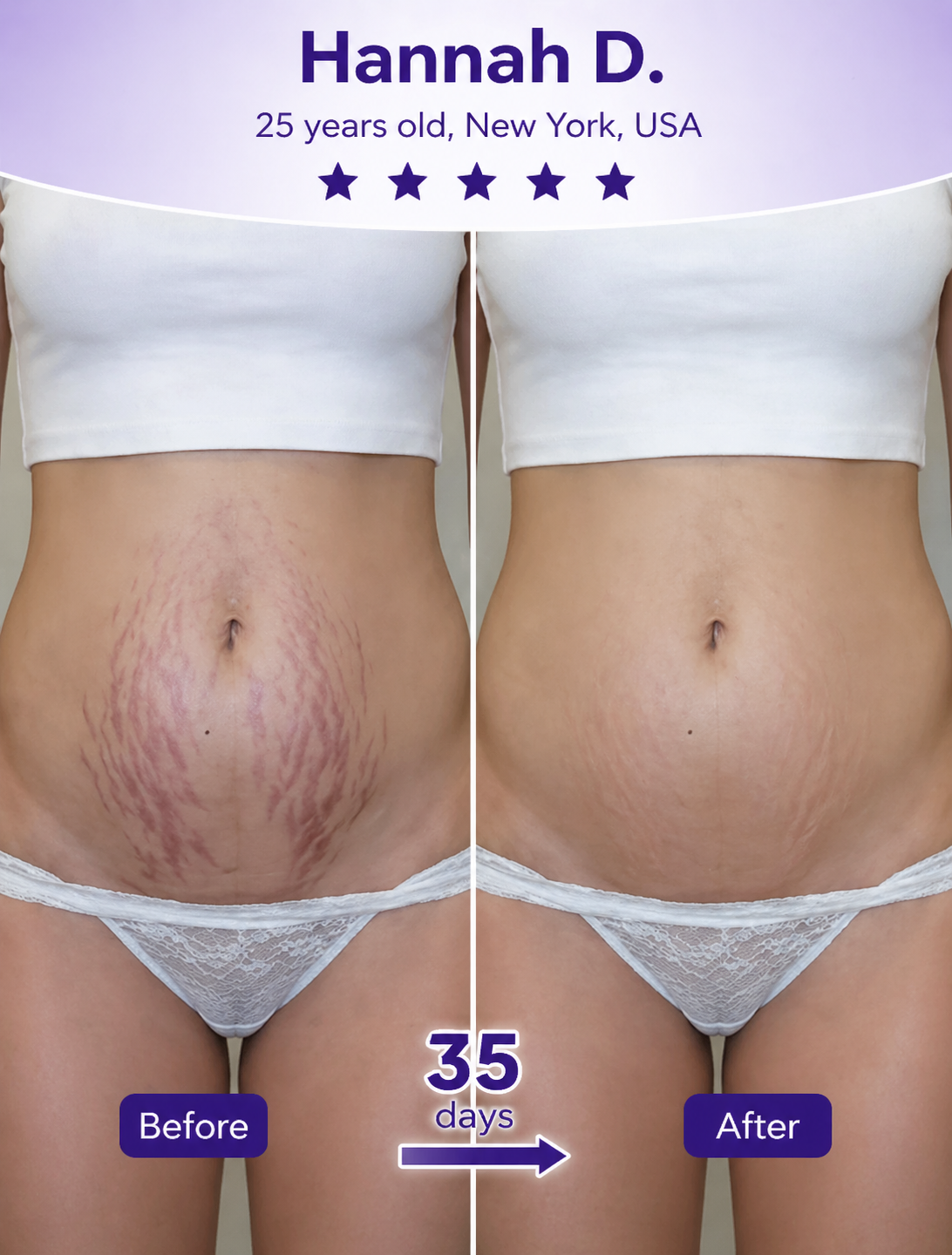 Scars & Stretch Marks Before & After