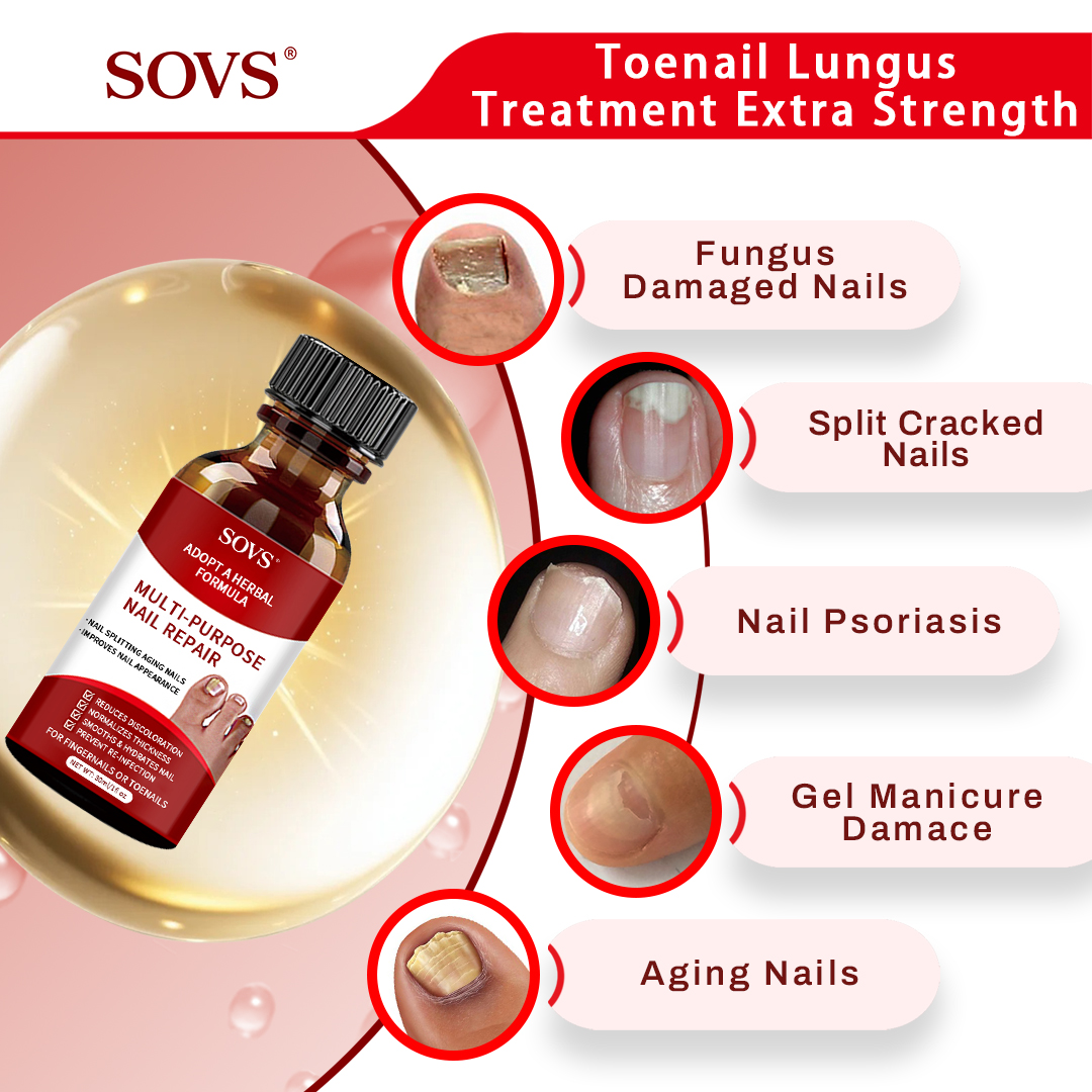 SOVS Toenail Fungus Treatment Extra Strength ,Antifungal Solution ,Triple Action Formula for Damaged Nails, Multi-Purpose Nail Repair,1 Fl Oz Manicure Therapy