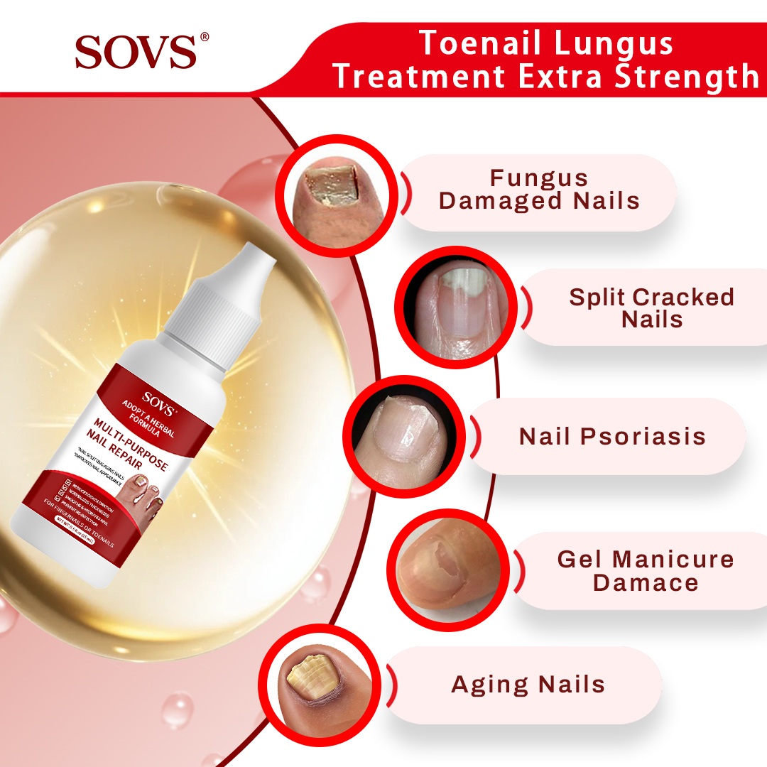 SOVS Toenail Fungus Treatment Extra Strength, Antifungal Solution for Toenail or Fingernail, Triple Action Formula for Remove Fungal, Repair and Renewal Damaged Nails, 0.5 Fl Oz