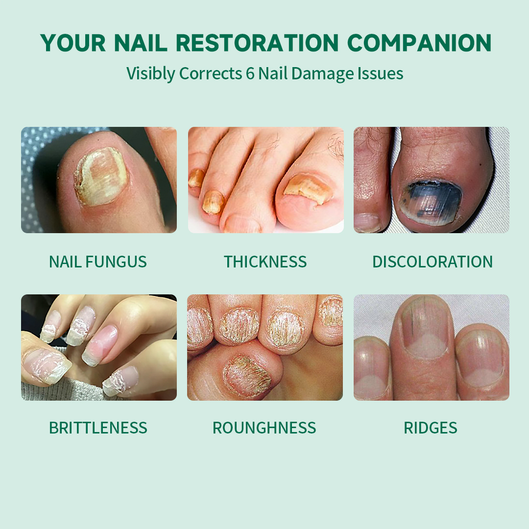 PUVIDA Fungal Nail Patches, 32 Pads Extra Strength Nail Repair Strips for Toenail & Fingernail, Restores Discolored, Thickened, Brittle Nails, 8-Week Nail Renewal Treatment