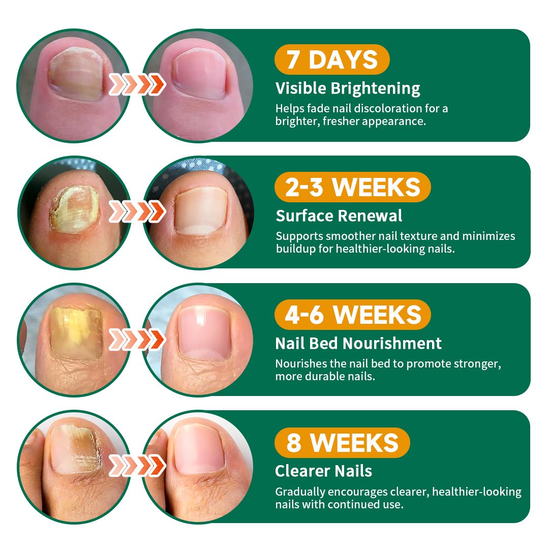 PUVIDA Fungal Nail Patches, 32 Pads Extra Strength Nail Repair Strips for Toenail & Fingernail, Restores Discolored, Thickened, Brittle Nails, 8-Week Nail Renewal Treatment