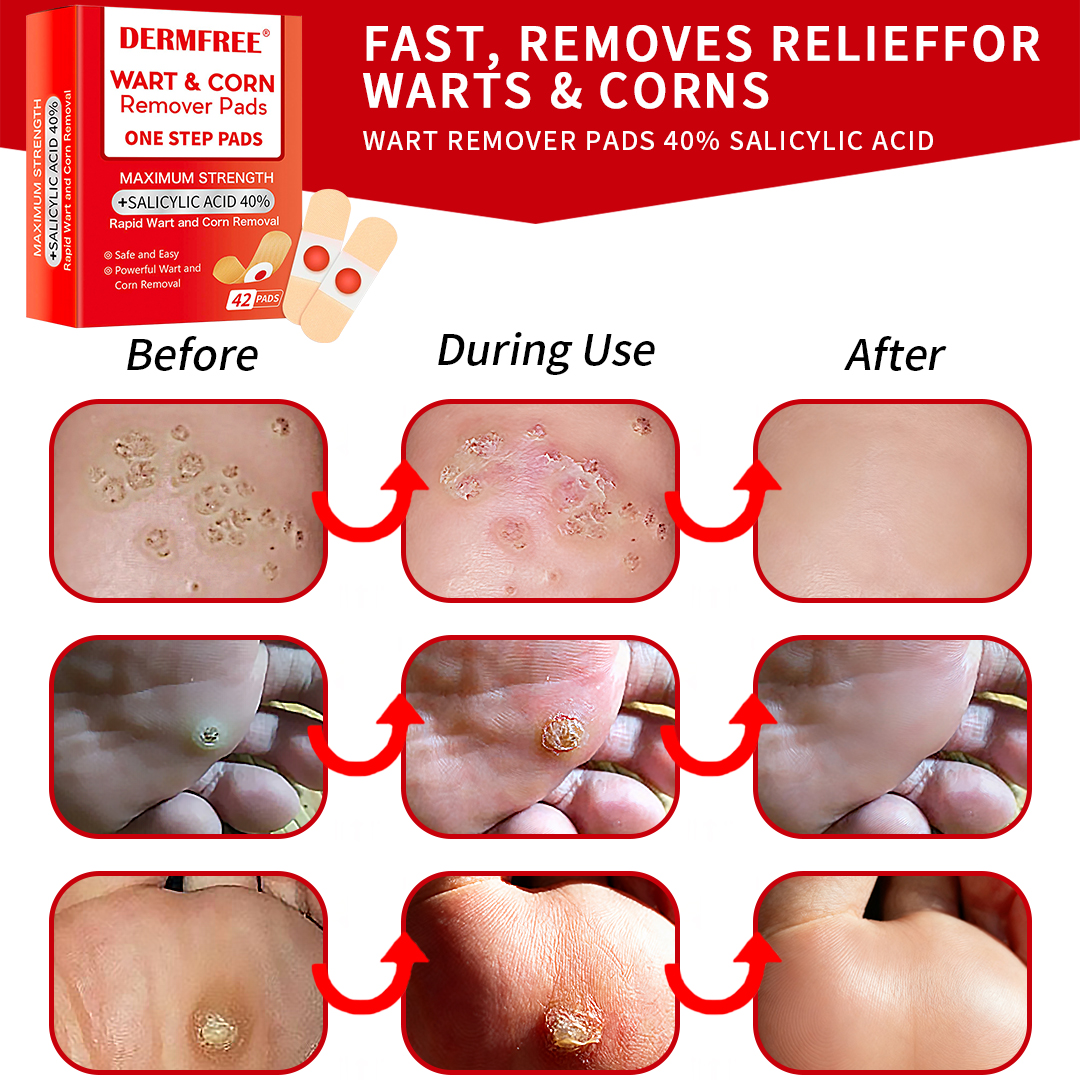 DERMFREE Wart & Corn Remover Pads - One Step Topical Pads