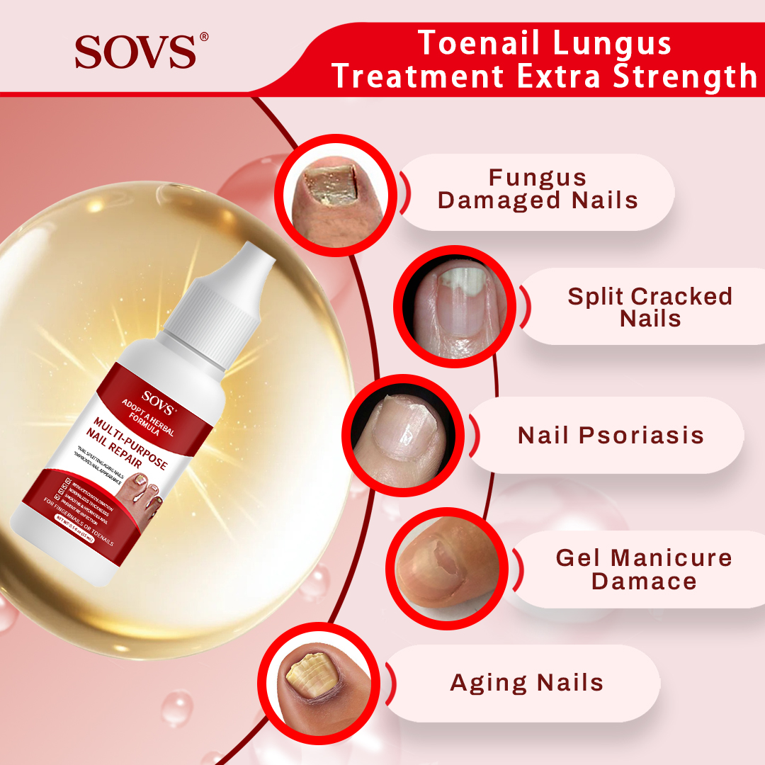SOVS Toenail Fungus Treatment Extra Strength, Antifungal Solution for Toenail or Fingernail, Triple Action Formula for Remove Fungal, Repair and Renewal Damaged Nails, 0.5 Fl Oz