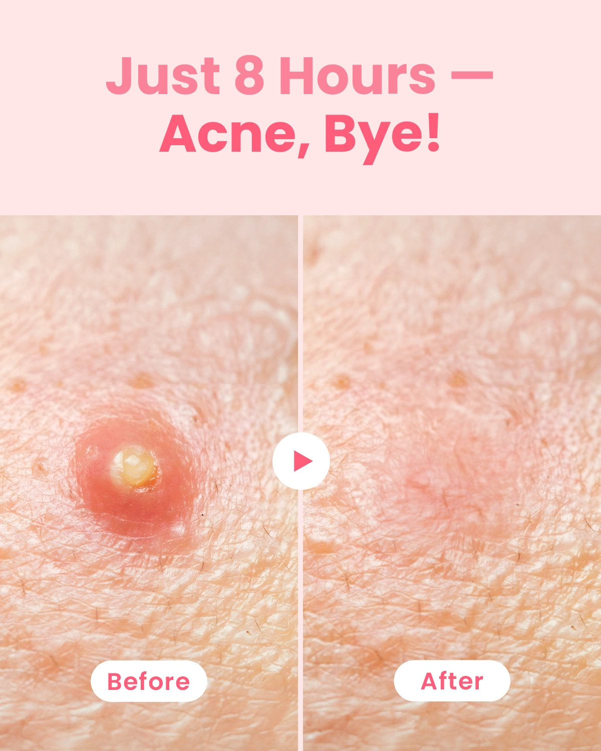 [GLAM UP] Hydrocolloid Blemish Pimple Zit Patches (36 Count/ 2 Sizes)