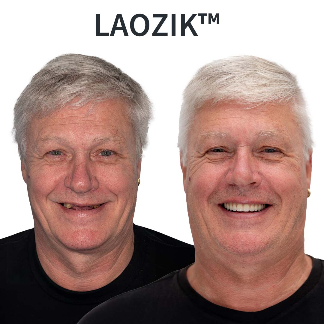 🦷 LAOZIKTM Custom-Fit Dentures ⏰ ENDS TODAY   70% OFF | Smile with Confidence