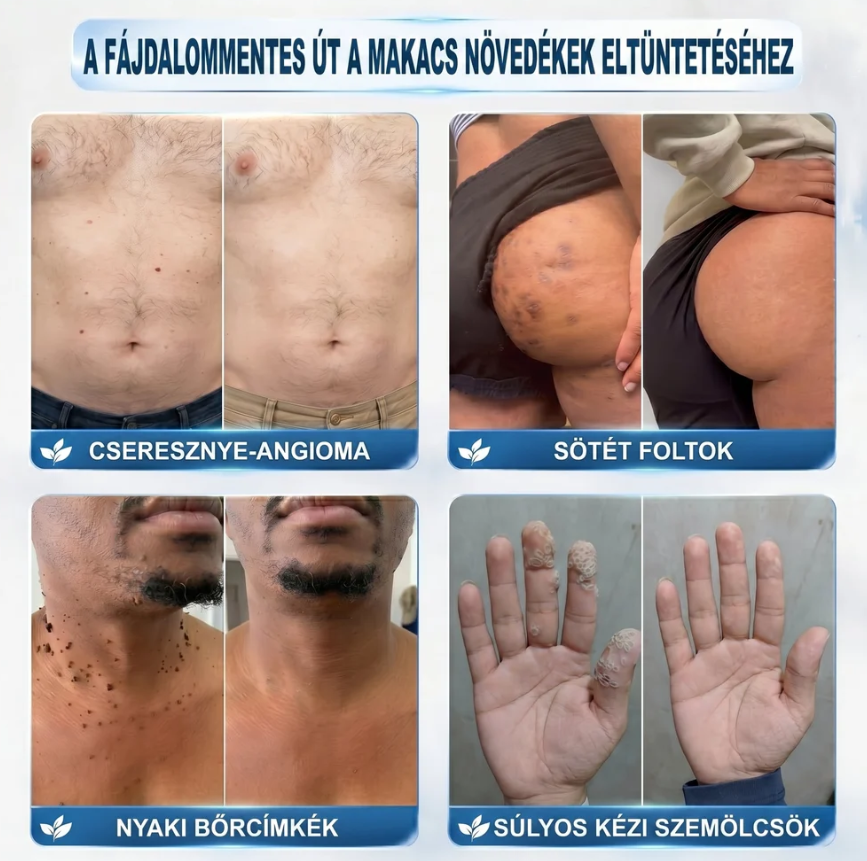 7 napos bőrkinövés‑ és folteltávolító Fájdalommentes és heg nélkül Fejlett roll‑on toll bőrhibák eltávolítására