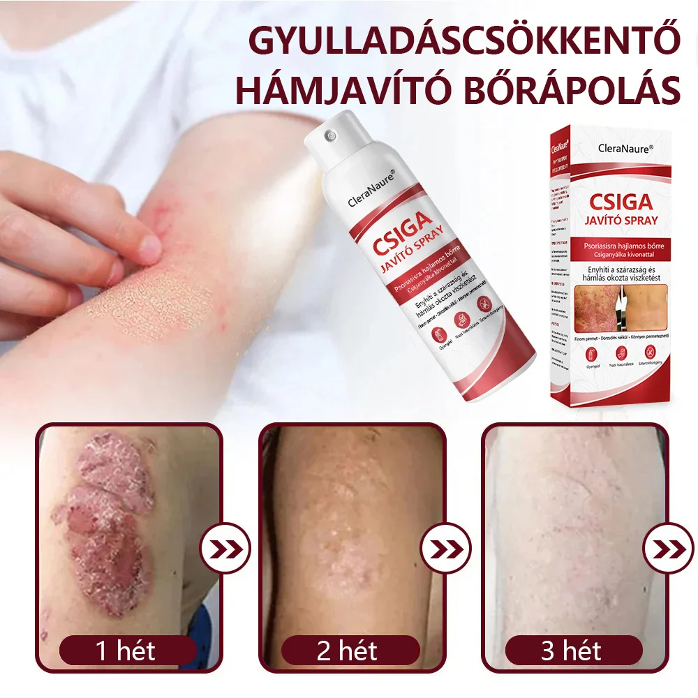 CleraNature® Bálnazsír Spray Viszkető, Hámló Psoriasisra Hajlamos Bőrre