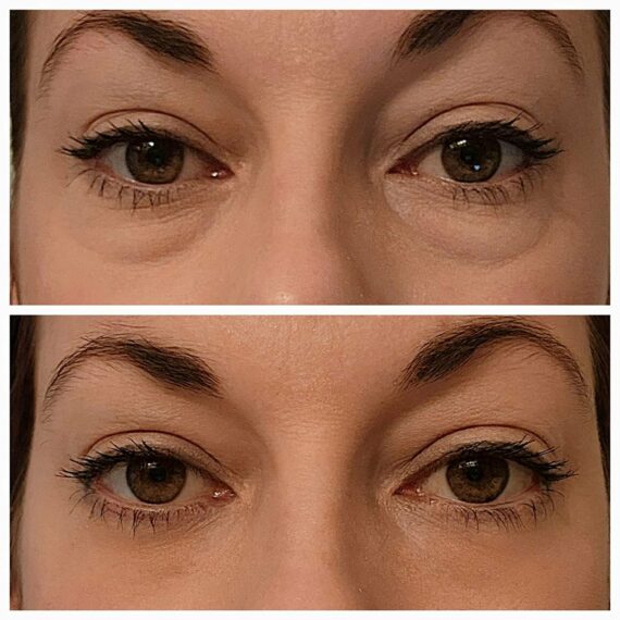 Quatinuetio - Instant FIRMx Eye Temporary Eye Tightener