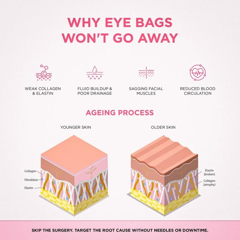 Why Eye Bags Won't Go Away Collagen Drainage Circulation