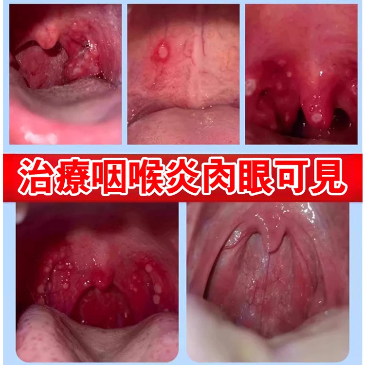 [Katakan Tidak pada Faringitis Kambuhan] Gel Faringitis & Tonsilitis Li Shizhen