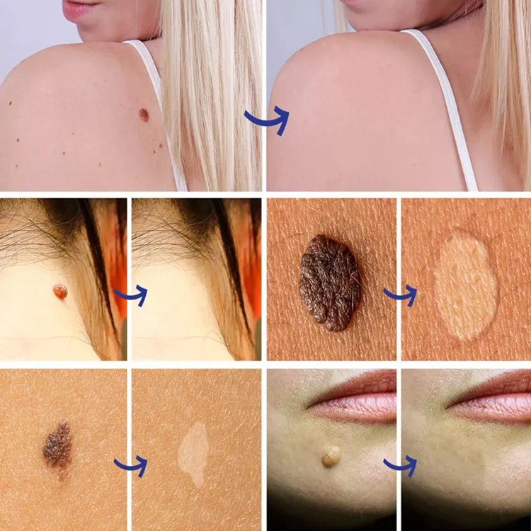 SLEELHOE Skin Care Patch Penghilang Kutil