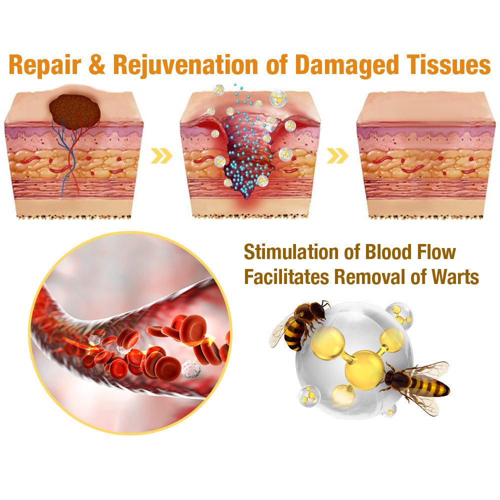 🐝BUY 1 GET 1 FREE🐝Bee Venom Mole and Wart Treatment Cream🍃[👨‍⚕AAD RECOMMENDS]