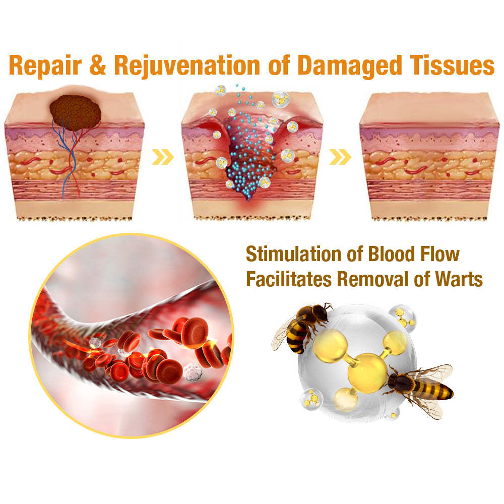 🐝BUY 1 GET 1 FREE🐝Bee Venom Mole and Wart Treatment Cream🍃[👨‍⚕AAD RECOMMENDS]